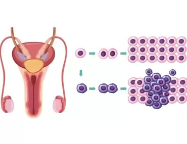 Testis Kanseri